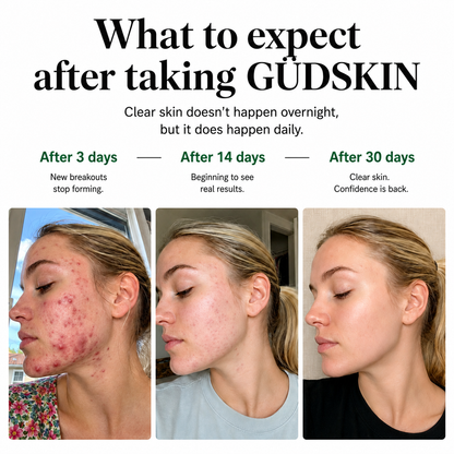 Acne Gummies